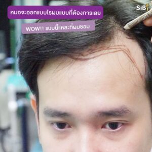 03 ปลูกผมถาวร