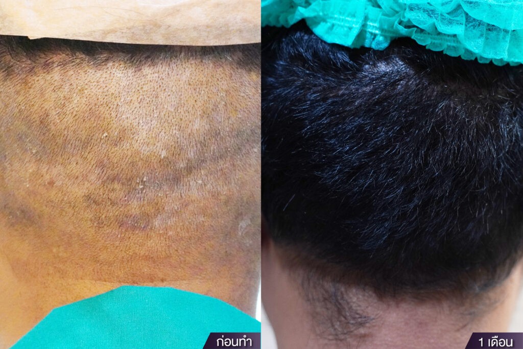 ศัลยกรรมปลูกผม Hair Transplant The SiB Plastic Surgery