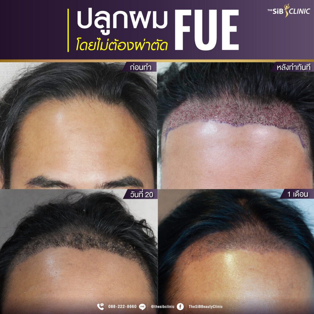 ศัลยกรรมปลูกผม Hair Transplant The SiB Plastic Surgery