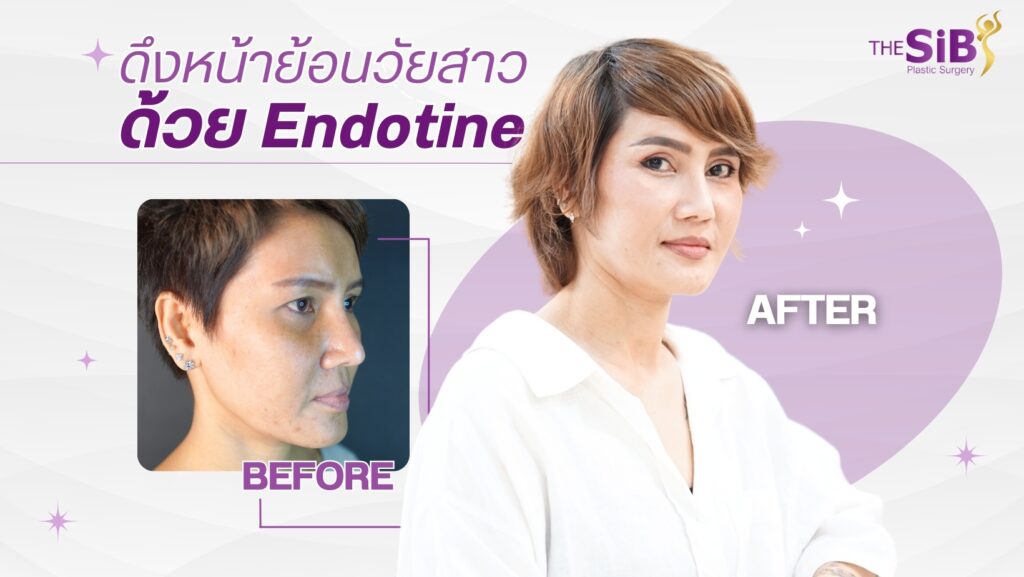 LINE ALBUM 230410 0 ดึงหน้า minifacelict endotine ย้อนวัยอีกครั้ง