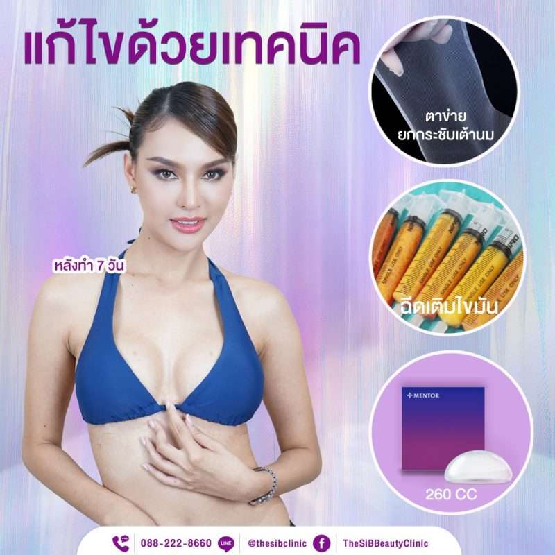 ตาข่ายล็อคหน้าอก