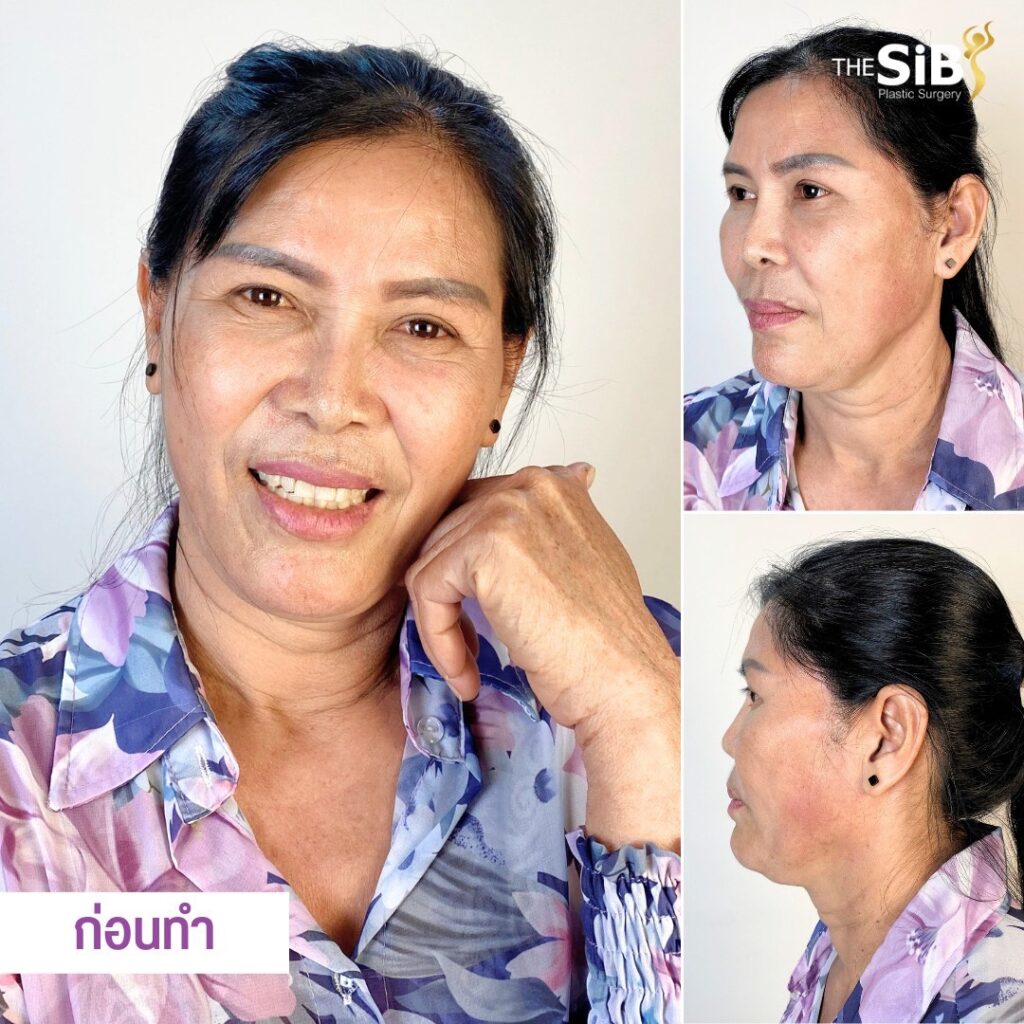 LINE ALBUM 230502 ดึงหน้าเปลี่ยนชีวิตงานแก้ที่ไหนไม่รับแต่ที่ คุณหมอดารินทร์ The SiB Plastic Surgery รับจบค่ะ