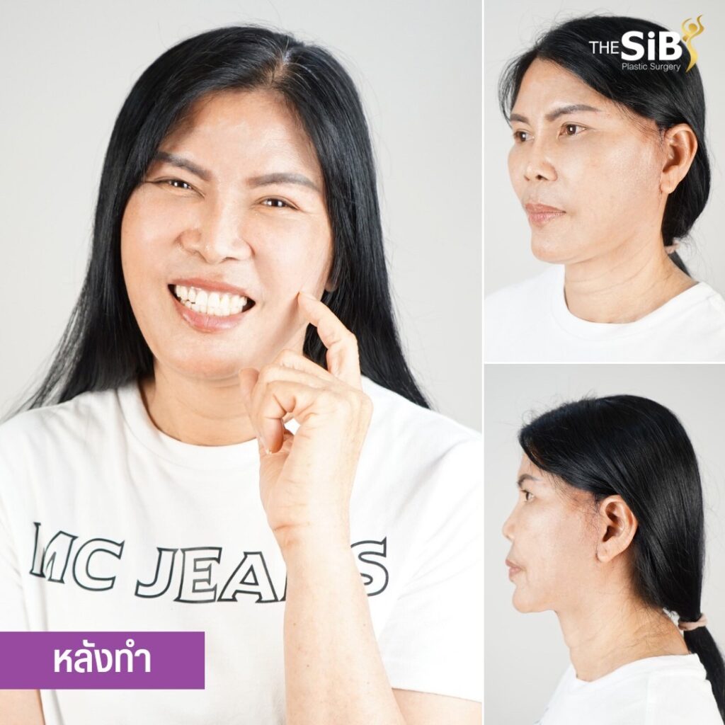 LINE AM 230502 ดึงหน้าเปลี่ยนชีวิตงานแก้ที่ไหนไม่รับแต่ที่ คุณหมอดารินทร์ The SiB Plastic Surgery รับจบค่ะ