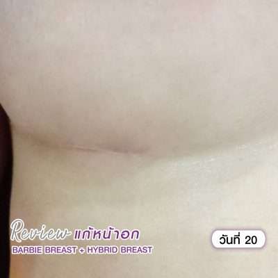 หน้าอกเข้าที่เมื่อไหร่ การดูแลตัวเองหลังเสริมหน้าอก ไม่ให้เกิดแผลเป็น