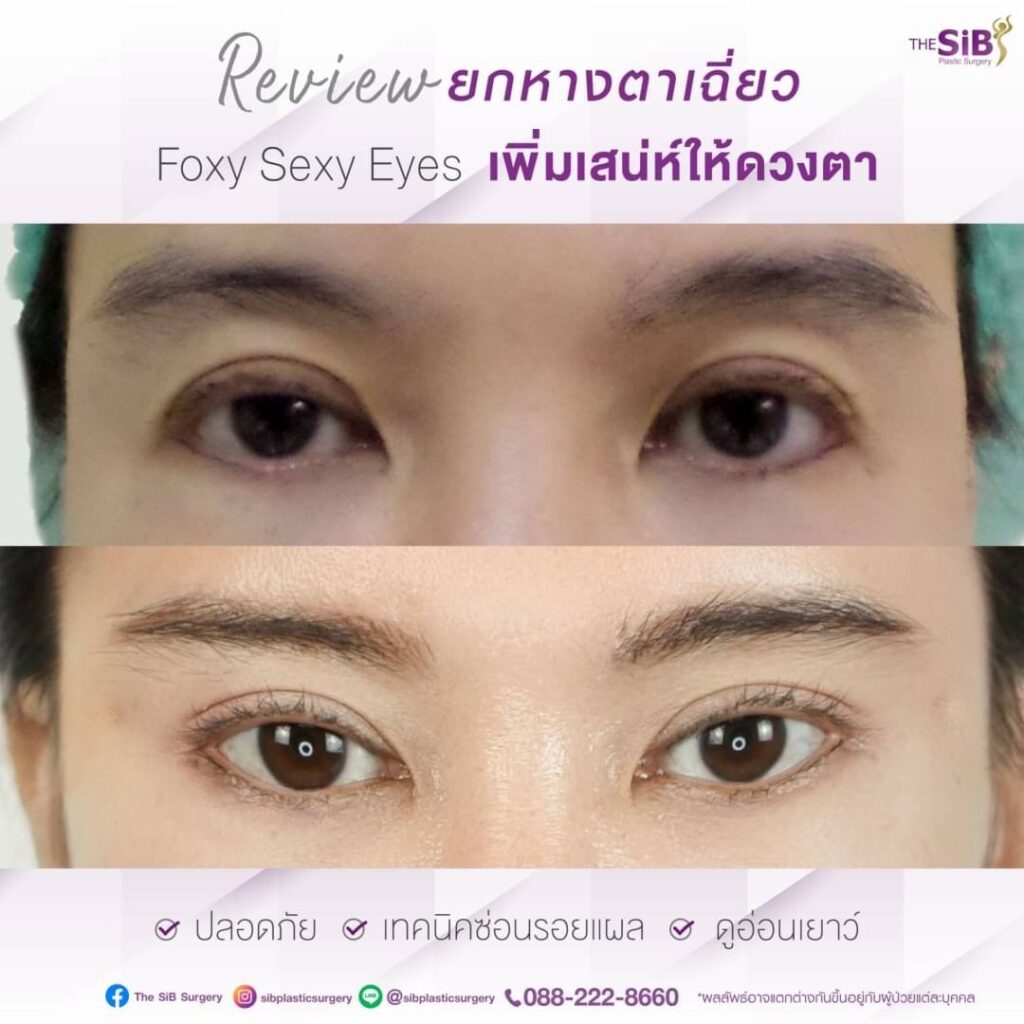 S 25034758 ย้อนวัย ตาสวยสดใสด้วยการทำ Foxy Eyes