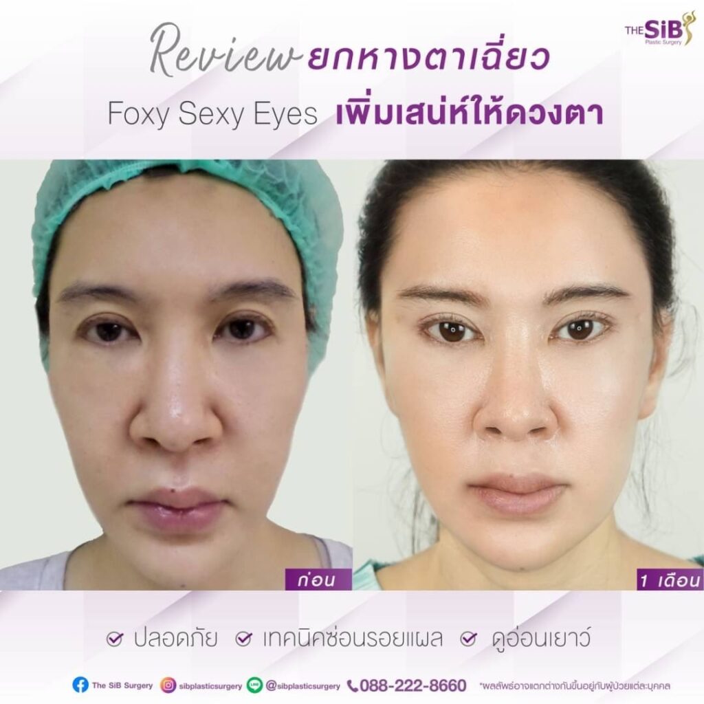 S 25034760 ย้อนวัย ตาสวยสดใสด้วยการทำ Foxy Eyes