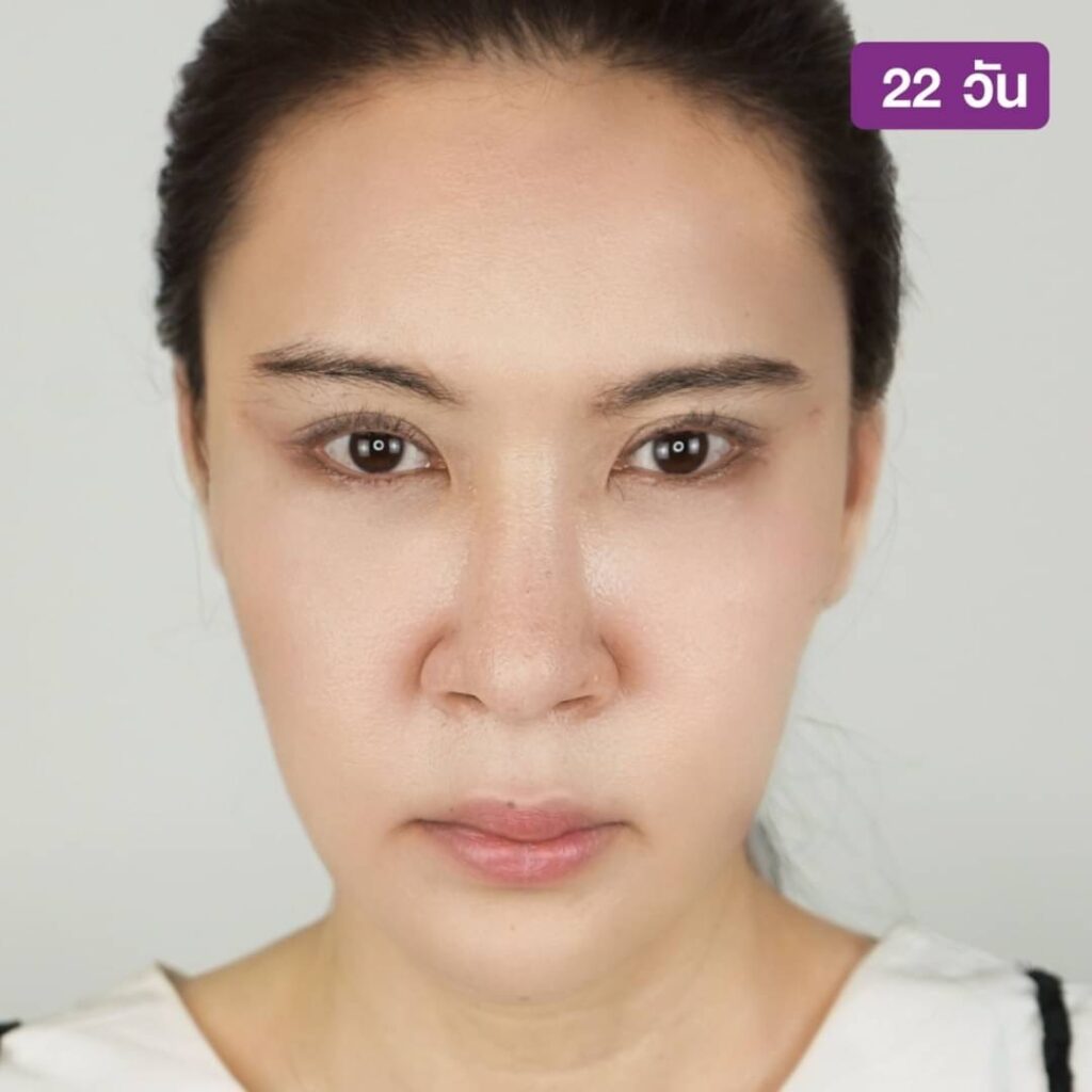 S 25034764 ย้อนวัย ตาสวยสดใสด้วยการทำ Foxy Eyes