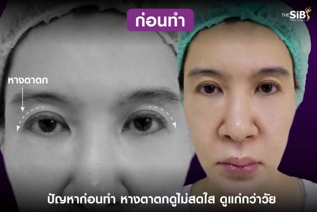 S 25034766 ย้อนวัย ตาสวยสดใสด้วยการทำ Foxy Eyes