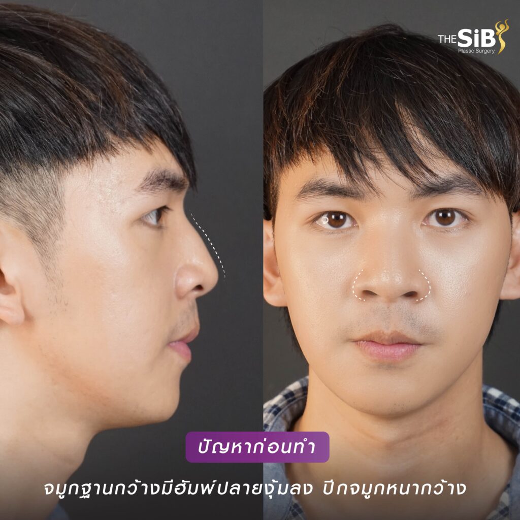 03 1 เสริมจมูก เทคนิค OPEN Rhinoplasty กระดูกอ่อนหลังหู ตะไบฮัพพ์+ตัดปีกจมูก