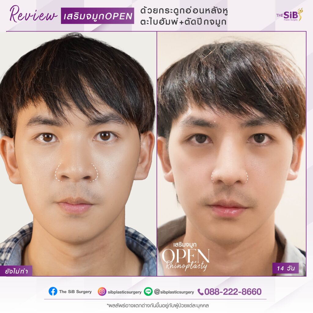 06 เสริมจมูก เทคนิค OPEN Rhinoplasty กระดูกอ่อนหลังหู ตะไบฮัพพ์+ตัดปีกจมูก