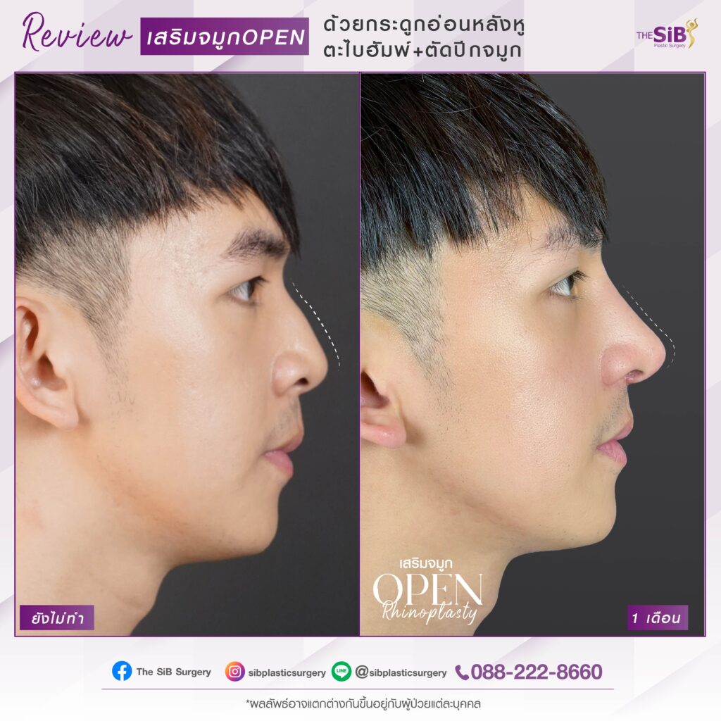 1 เดือน ENG 01 เสริมจมูก เทคนิค OPEN Rhinoplasty กระดูกอ่อนหลังหู ตะไบฮัพพ์+ตัดปีกจมูก