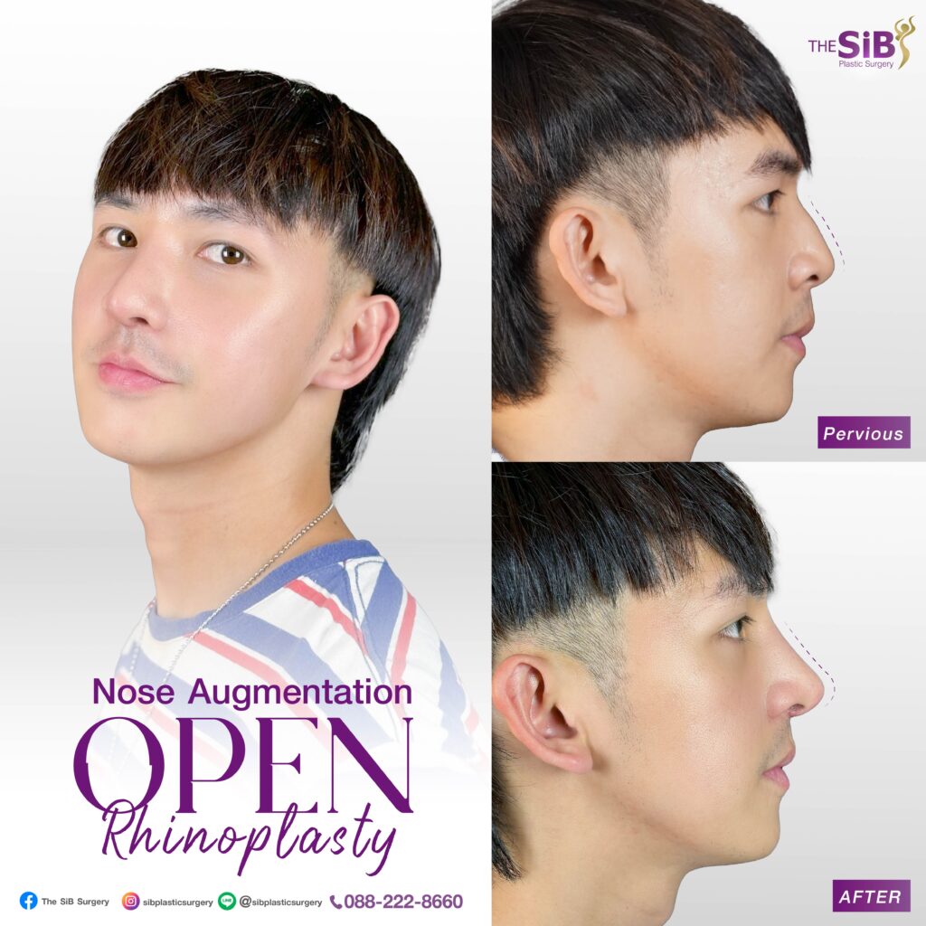 1 เดือน ENG 05 เสริมจมูก เทคนิค OPEN Rhinoplasty กระดูกอ่อนหลังหู ตะไบฮัพพ์+ตัดปีกจมูก