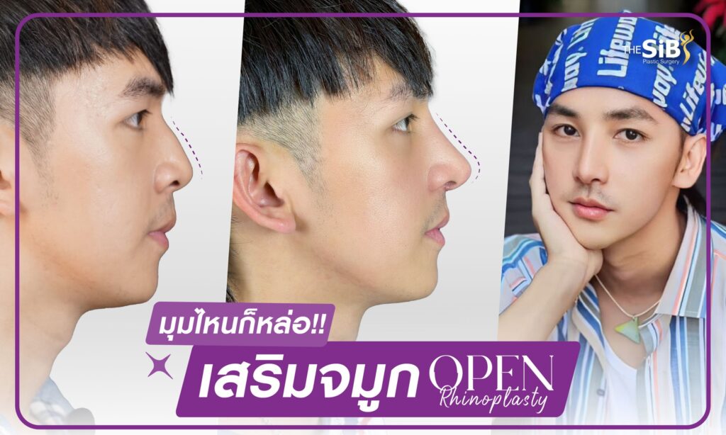 01 เสริมจมูก เทคนิค OPEN Rhinoplasty กระดูกอ่อนหลังหู ตะไบฮัพพ์+ตัดปีกจมูก