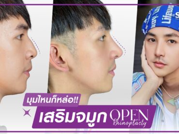 01 เสริมจมูก เทคนิค OPEN Rhinoplasty กระดูกอ่อนหลังหู ตะไบฮัพพ์+ตัดปีกจมูก