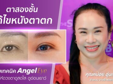 S 30892056 ลำดวนบางรัก ซอย 9 แก้ไขหนังตาตกกับคุณหมอดารินทร์ ที่ thesib clinic 