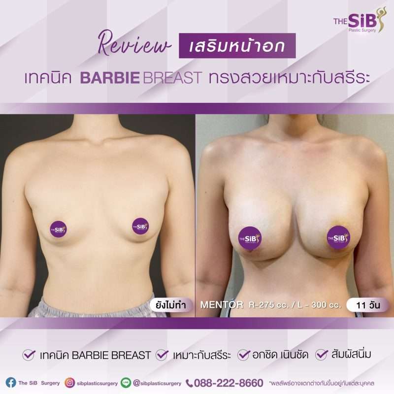 หน้าอกสวย ธรรมชาติ เนรมิตได้กับแพทย์หญิงอันดับ 1 ของเมืองไทย