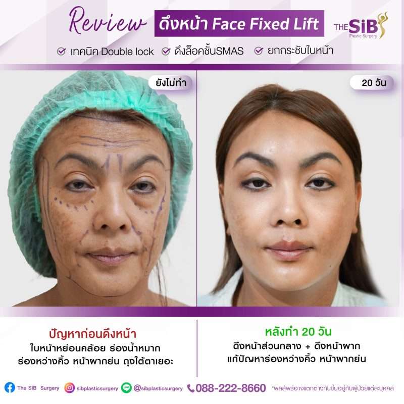 ศัลยกรรมดึงหน้า Face Lock  เทคนิค Double lock