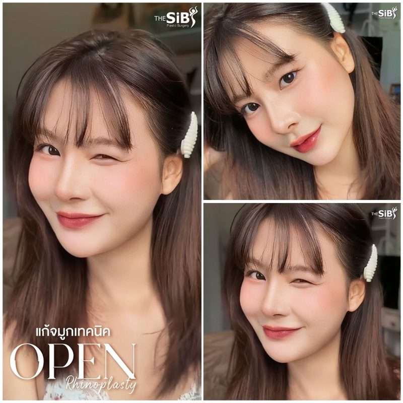 แก้จมูกแบบเซมิโอเพ่น semi open ปรับหน้าแข็งให้ดูหวานในพริบตา แก้จมูกแบบเซมิโอเพ่น semi open ปรับหน้าแข็งให้ดูหวานในพริบตา