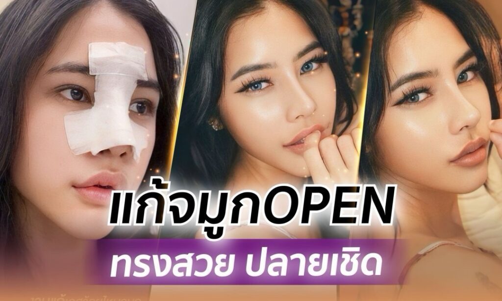 S 30482440 0 แก้จมูก OPEN บวกกระดูกอ่อนหลังหู ทรงสวย ปลายเชิด หน้าเป๊ะ