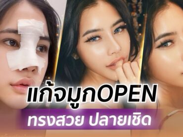 S 30482440 0 แก้จมูก OPEN บวกกระดูกอ่อนหลังหู ทรงสวย ปลายเชิด หน้าเป๊ะ