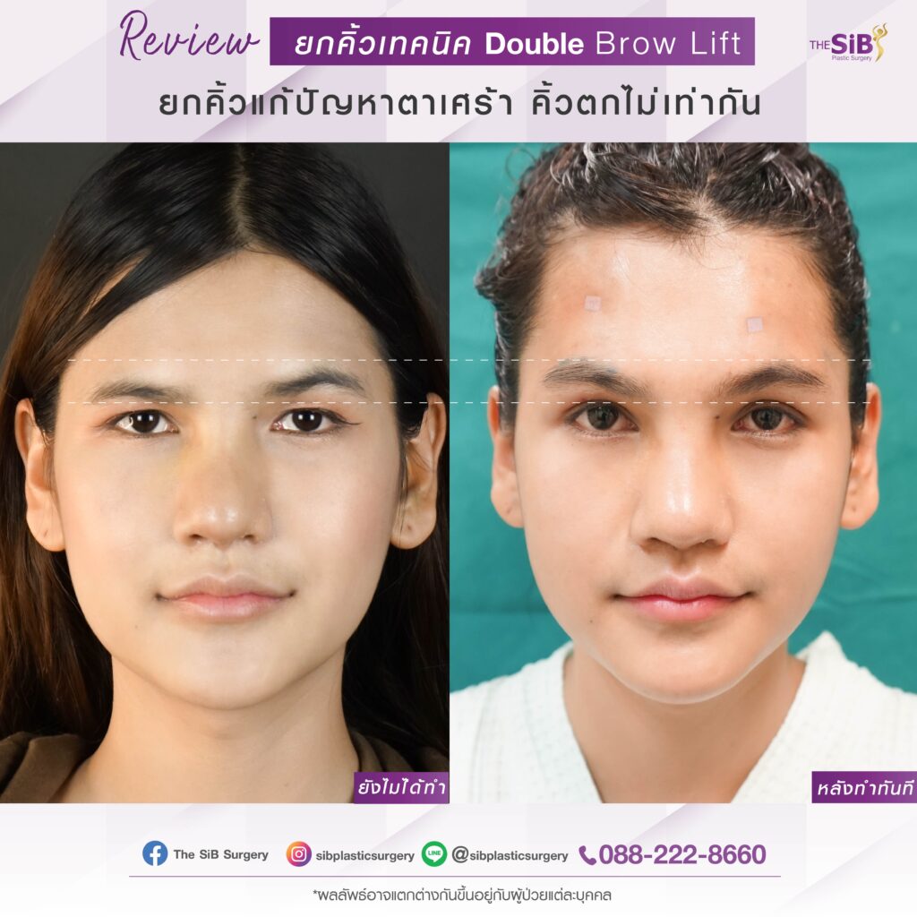 Double brow lift แพนทีน 01 ยกคิ้วเติมไขมันหน้า สาว LGBQ