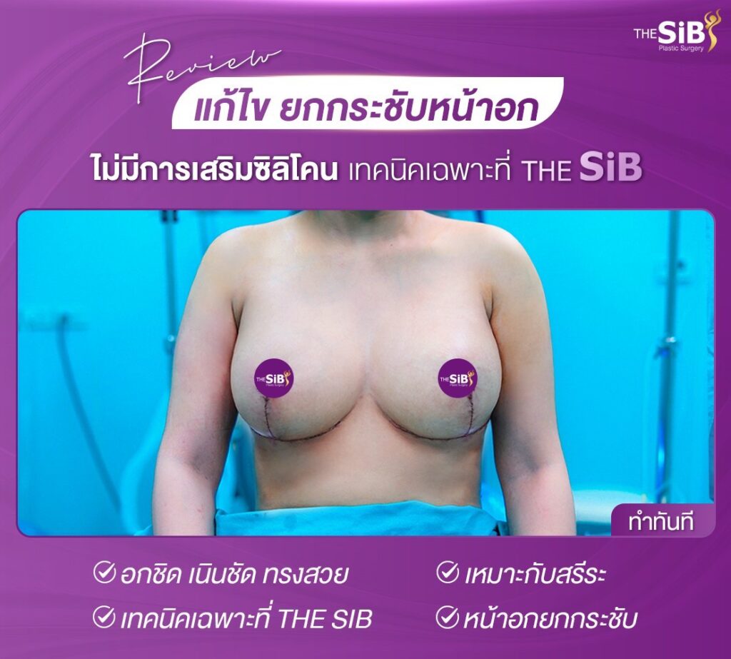 C65239D8 5E36 46EE 8BCF 3290CBACDF0D แก้หน้าอกหย่อนคล้อย คุณอ้อม