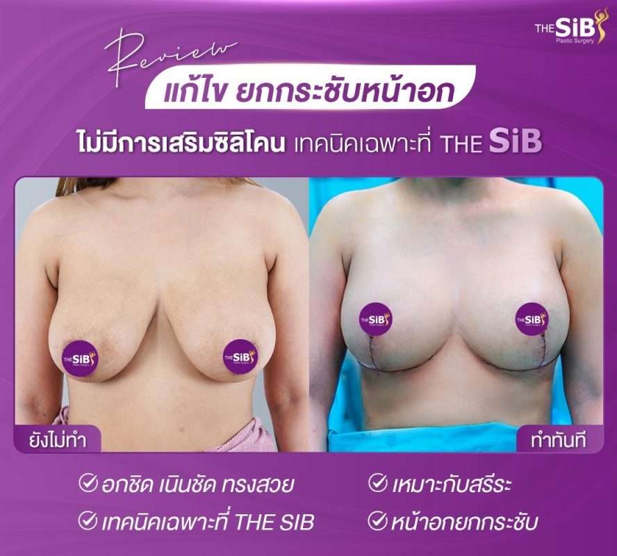 แก้หน้าอกหย่อนคล้อย อกเสียทรงไม่ได้รูป อกไม่กระชับ