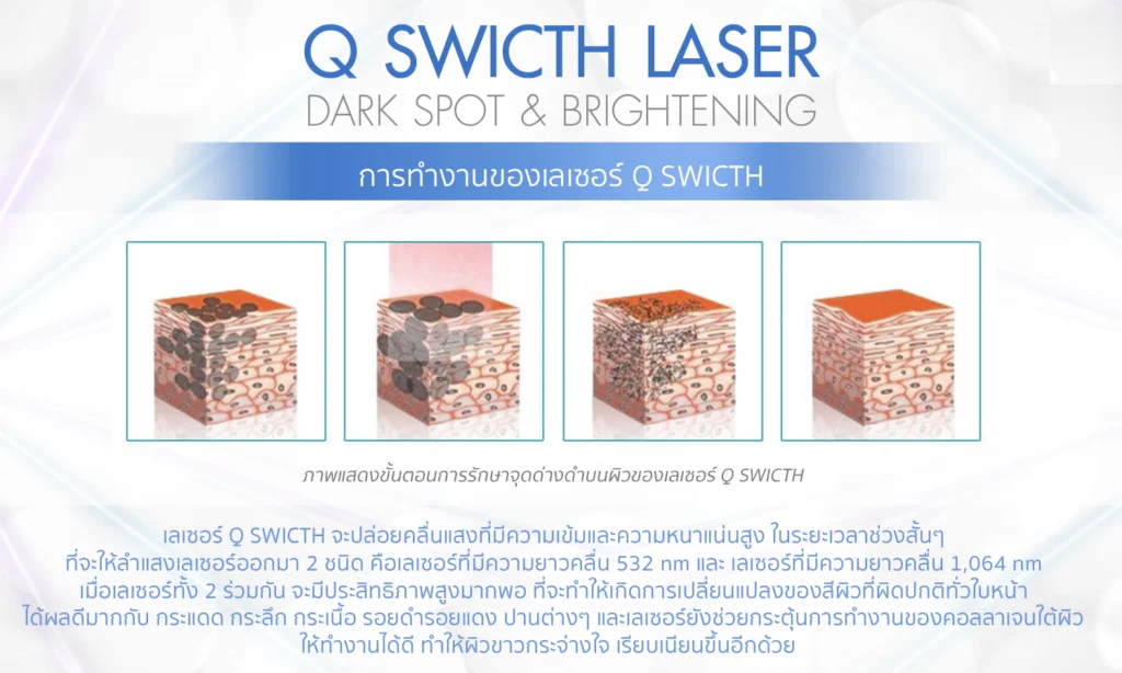 q switch02 Q-switch ลดกระฝา จุดด่างดำ หน้าใส