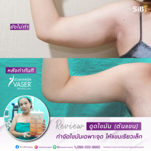 ดูดไขมันต้นแขน-01