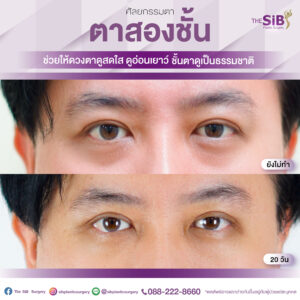 ตาสองชั้นคุณบิ๊ก-01