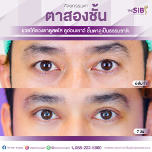 ตาสองชั้นคุณอาท14วัน-01