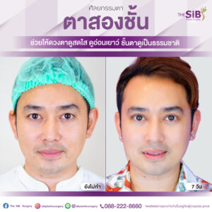 ตาสองชั้นคุณอาท14วัน-02