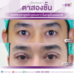 ตาสองชั้นคุณอาทหลังทำทันที-01