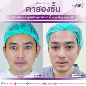 ตาสองชั้นคุณอาทหลังทำทันที-02