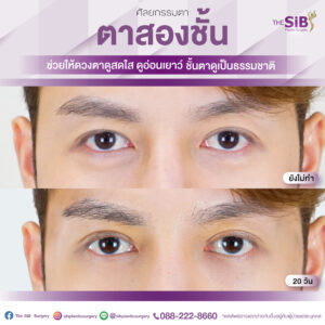 ตาสองชั้นคุณโด่ง-01