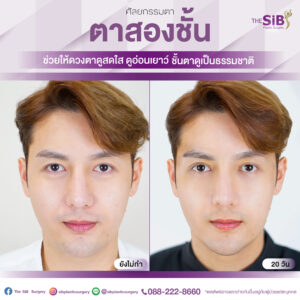 ตาสองชั้นคุณโด่ง-02