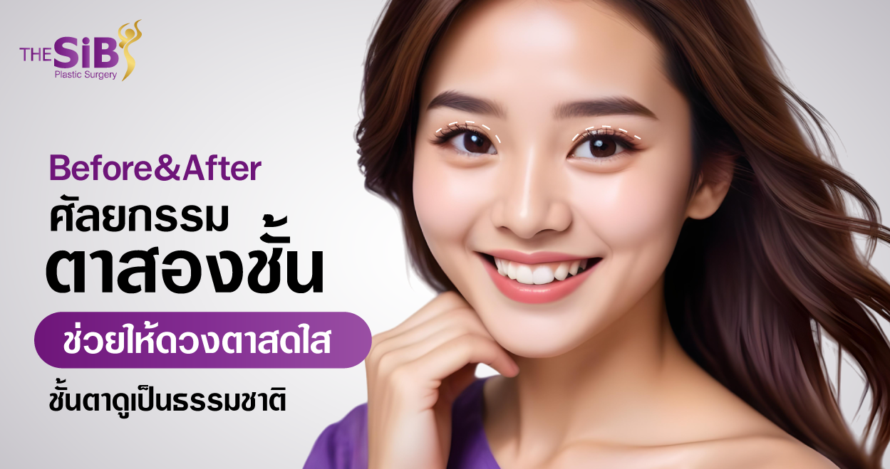 banner BF ตาสองชั้น Before&After_Upper Eyelid