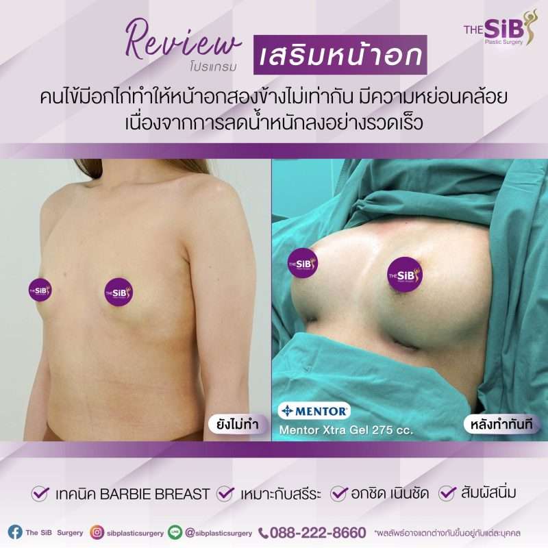 หน้าอกห่าง คืออะไร ภาวะอกไก่