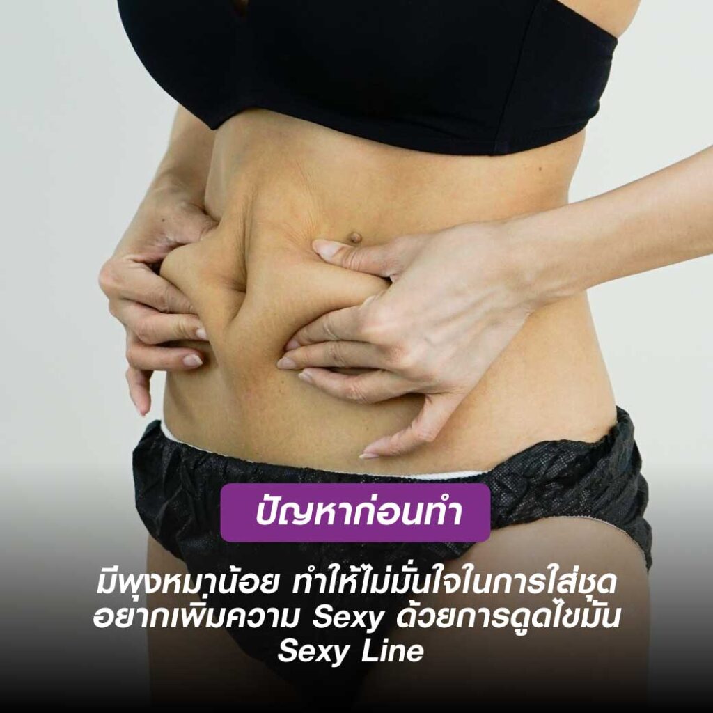 Sexy line3 ดูดไขมันส่วนเกิน ปรับเอวให้เป็นเอวเอส