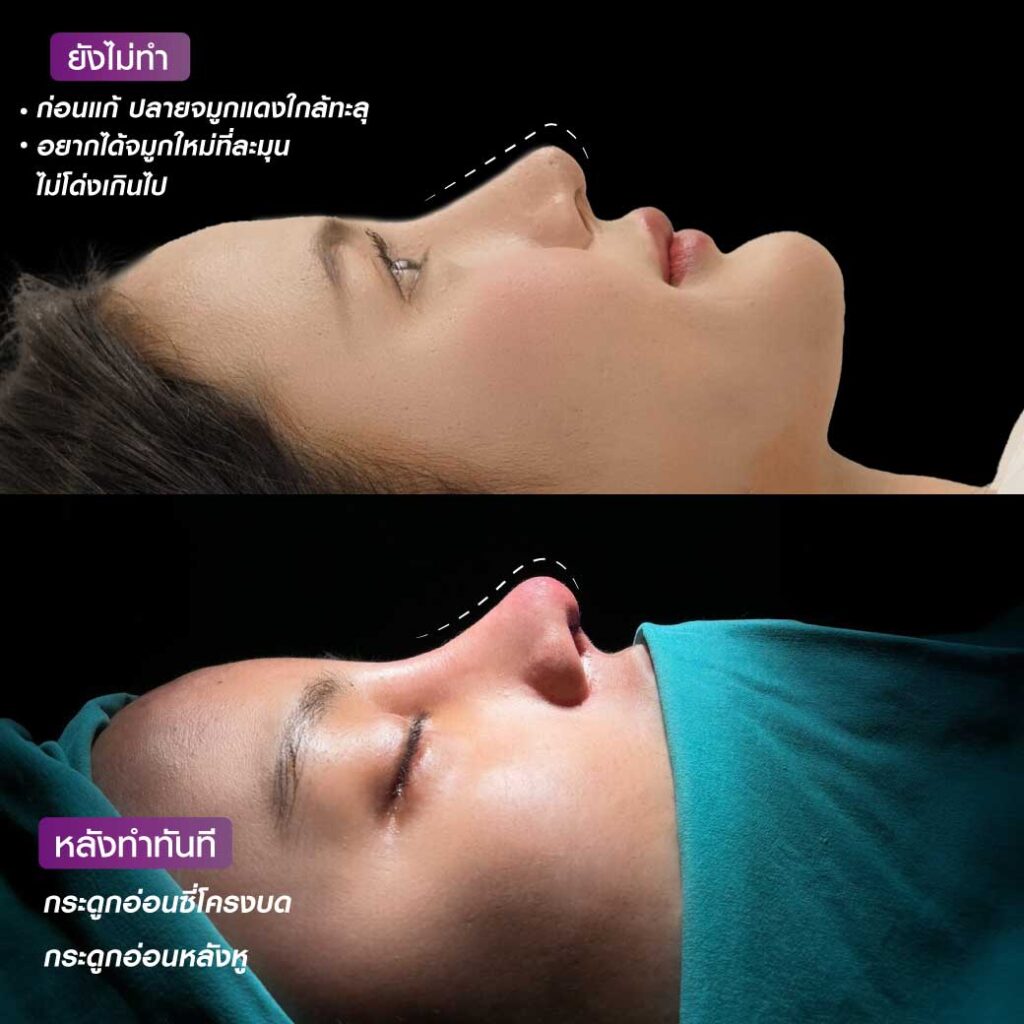 3 แก้จมูกใหม่หน้าสวยสดใส น่ารักกว่าเดิม กับคุณแอนนี่นักธุรกิจสาวไฟแรง