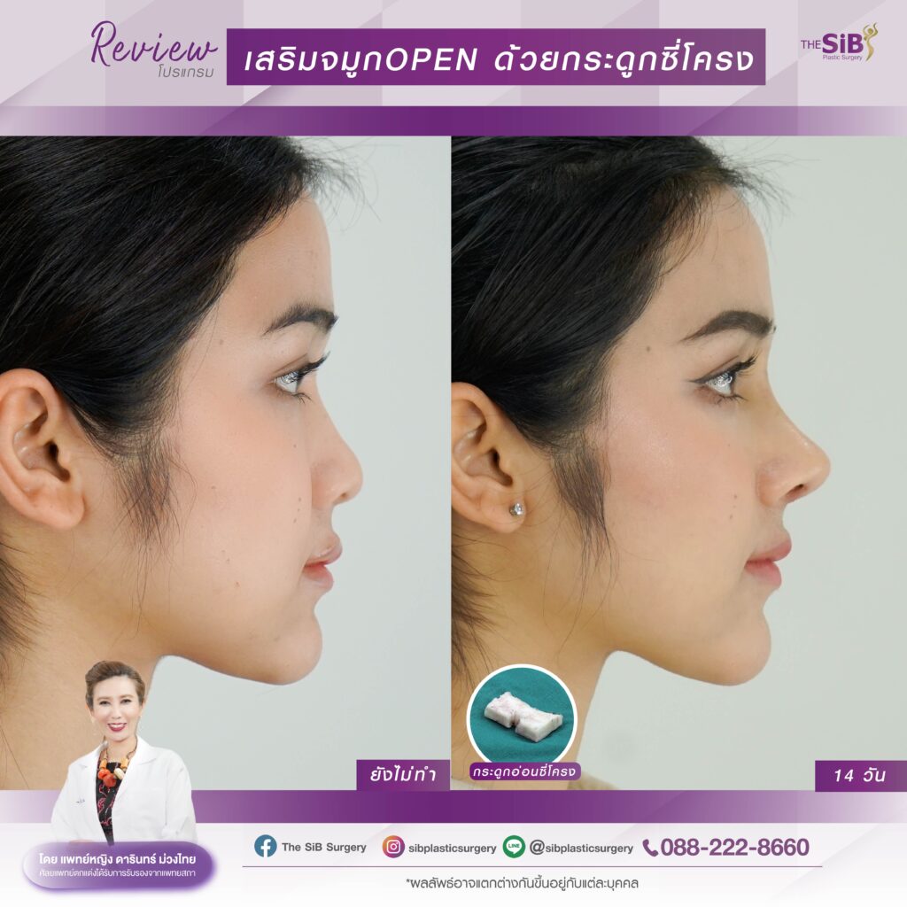 7วัน 04 Copy เสริมจมูกแบบโอเพ่น น้องออมเสริมจมูกใหม่