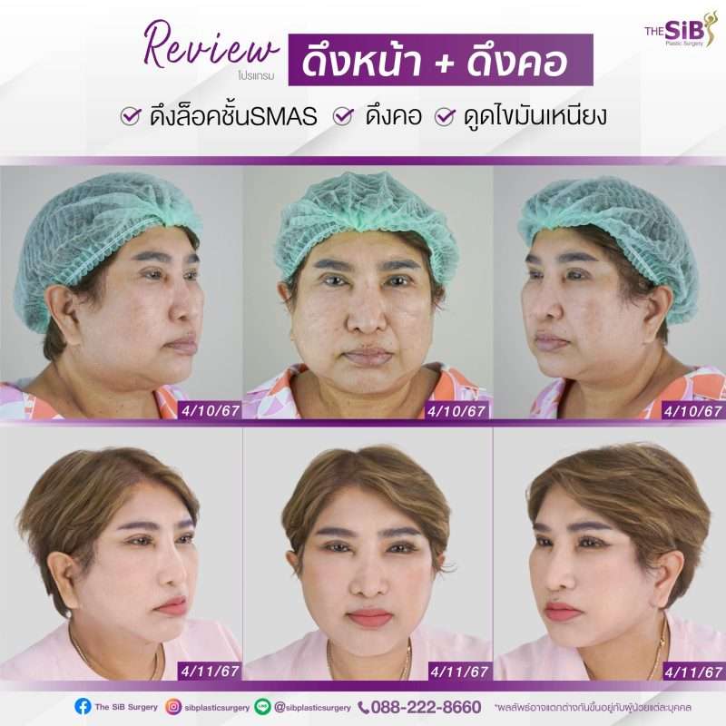  แชร์ประสบการณ์ ดึงหน้า ให้กลับมาสวยเหมือนสาว 30 อีกครั้ง