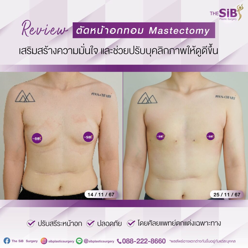 14วัน 01 ตัดหน้าอกทอม เปลี่ยนเป็นหนุ่มหล่อในพริบตา