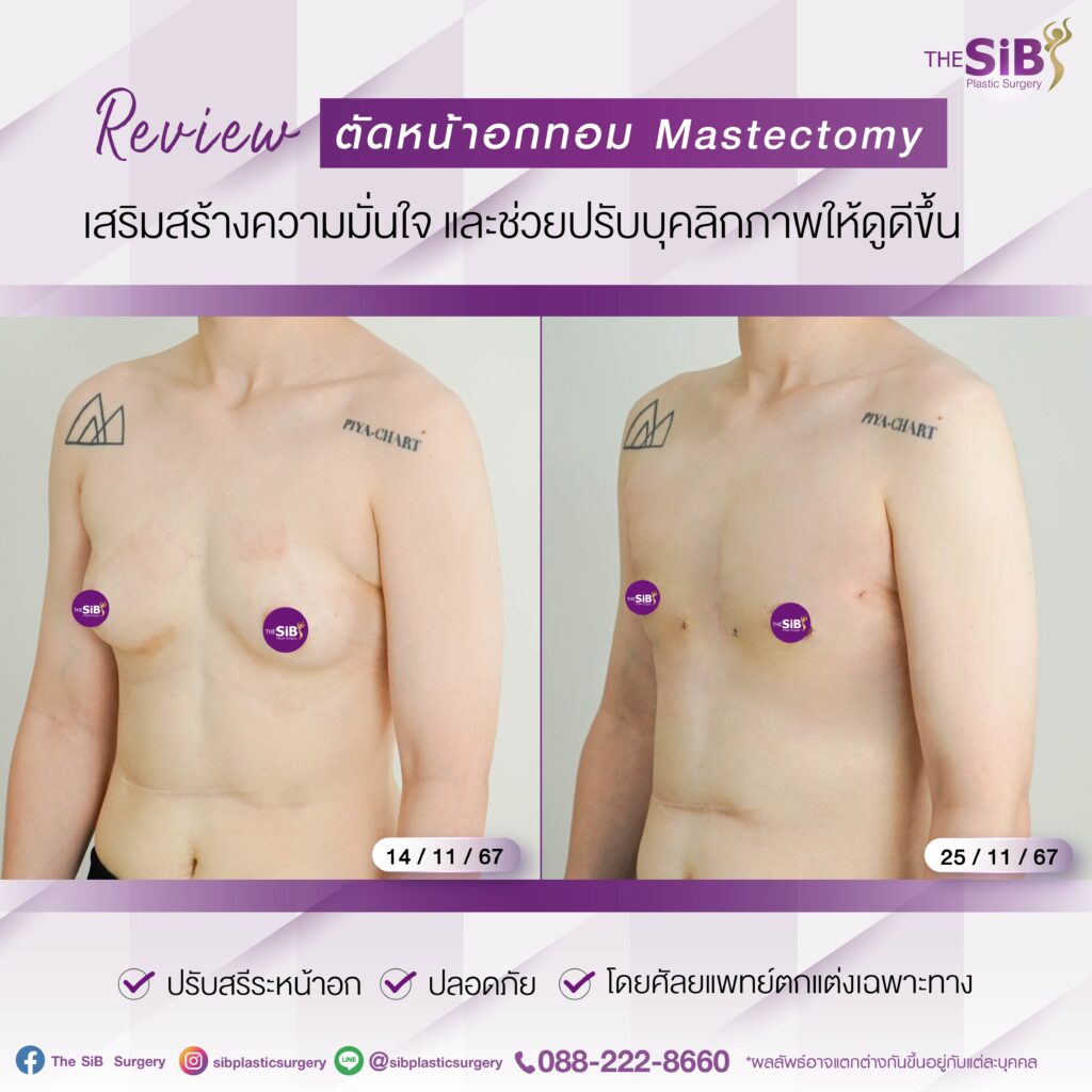 14วัน 02 ตัดหน้าอกทอม เปลี่ยนเป็นหนุ่มหล่อในพริบตา