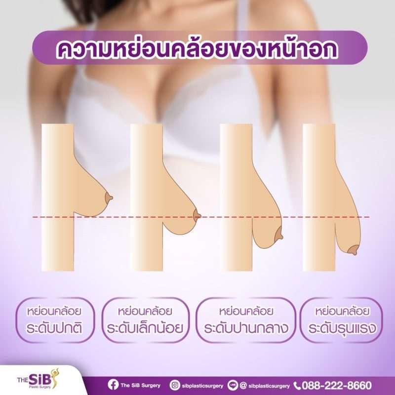 หน้าอกหย่อนคล้อย