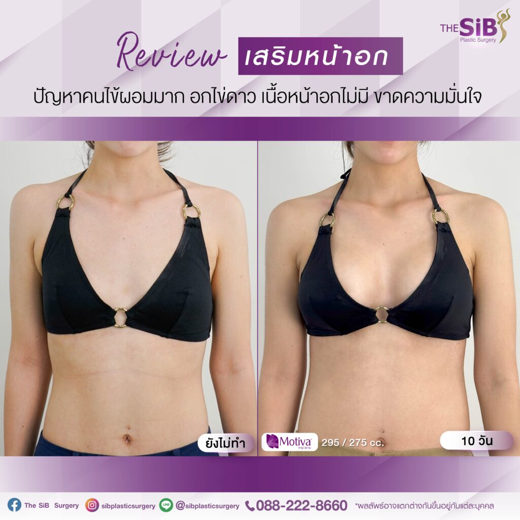 14 วัน 02 อกสวยในพริบตาเสริมหน้าอกใหม่ 295 cc ด้านขวา 275cc ด้านซ้าย