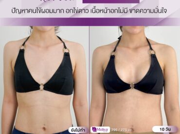 14 วัน 02 อกสวยในพริบตาเสริมหน้าอกใหม่ 295 cc ด้านขวา 275cc ด้านซ้าย