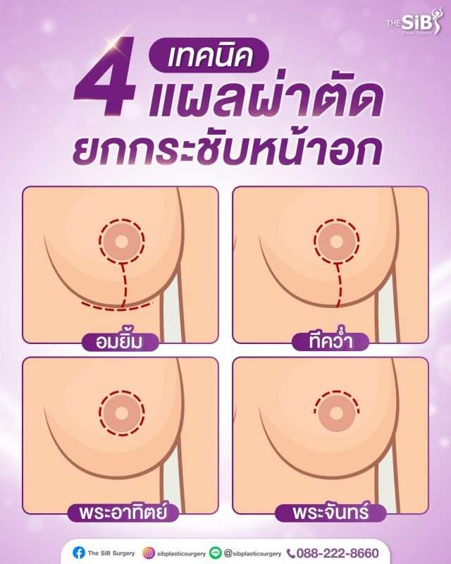 แผลผ่าตัดยกกระชับหน้าอก