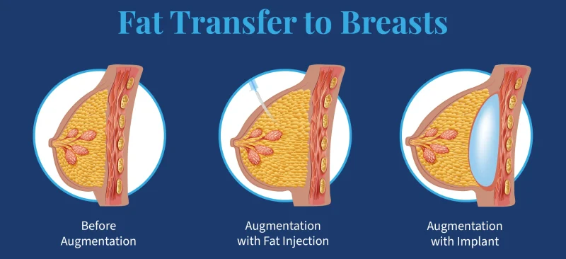 Hybrid Breast