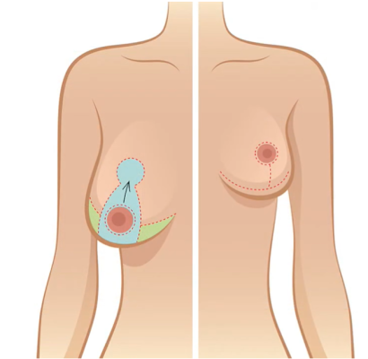 ทำไมต้องลดขนาดหน้าอก